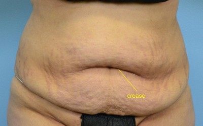 Belly Crease