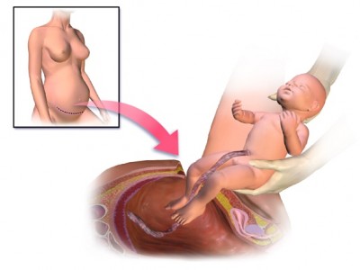 C-Sections are Never Pleasant