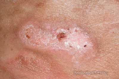 Ulcers that do not clear up