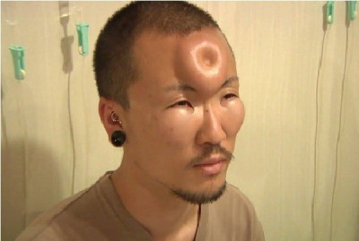 Forehead implant