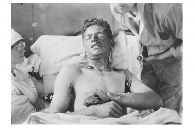 Mustard Gas Tested On Soldiers