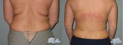 Fatty Pads