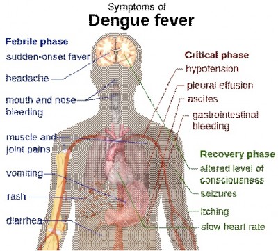 Dengue Fever