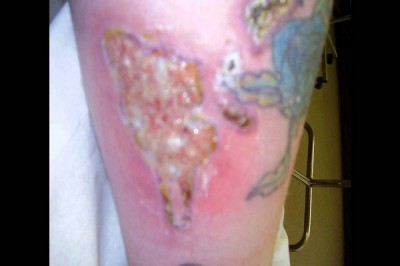 Tattoo removal disasters