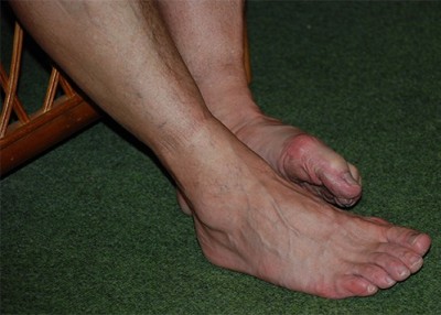 Sore Feet
