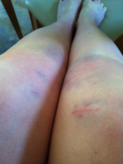 Sore Knees