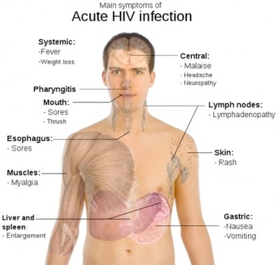 HIV