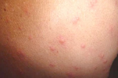 Check For Bites
