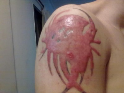 Scarring