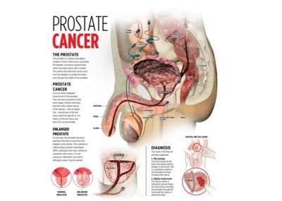 Fights Prostate Cancer