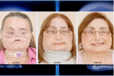 Connie Culp - First Human Face Transplant