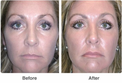 Kissing a guy feels different after lip implants