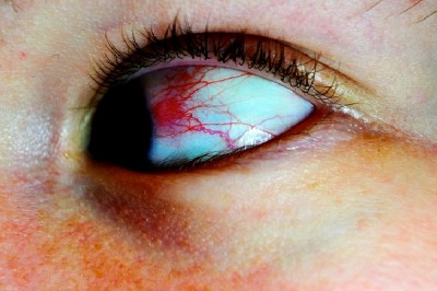 Bloodshot Eyes