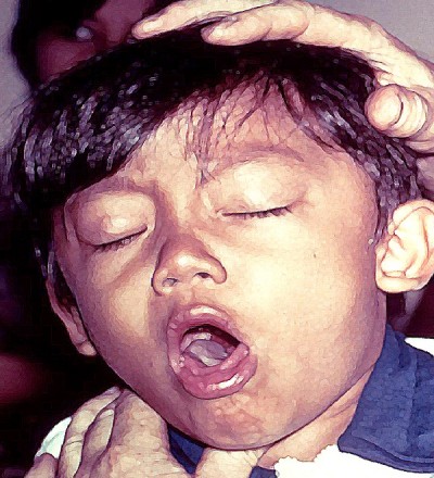 Whooping Cough