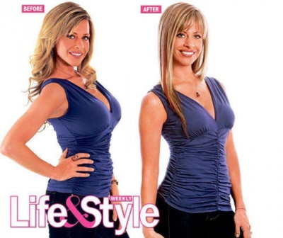 Dina Manzo Before and after Breast Reduction Surgery