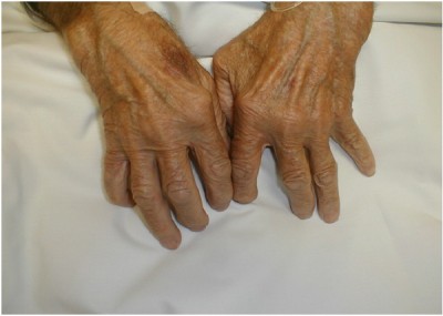 Relieving Arthritis Symptoms