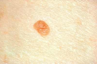 Changes in your skin or moles
