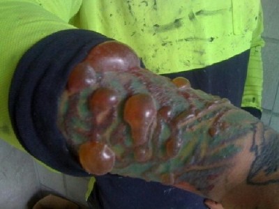 Blood blisters