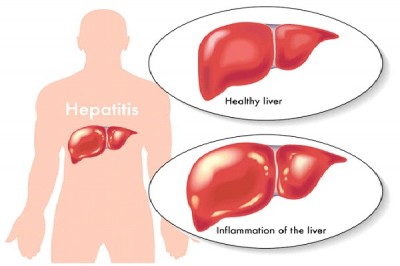 Hepatitus