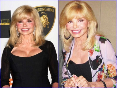 Loni Anderson Before And After Breast Reduction Surgery