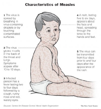 Measles