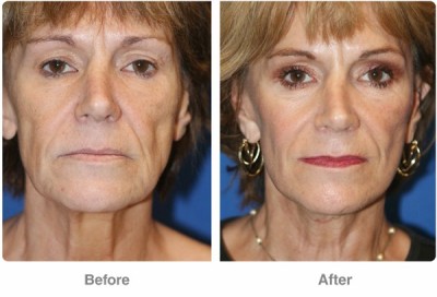 Women get face lift earlier than men