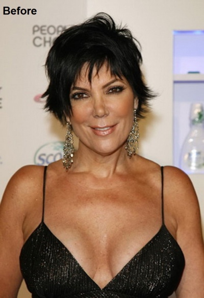 Kris Jenner Before and after Breast Reduction Surgery