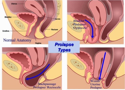 Uterus Can Fallout