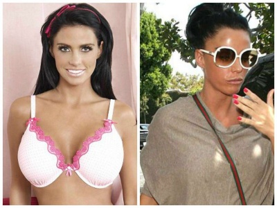 Katie Price Before and after Breast Reduction Surgery