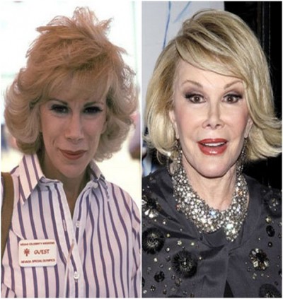 Joan Rivers (Before & After)