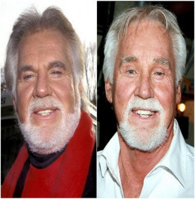 Kenny Rogers (Before & After)